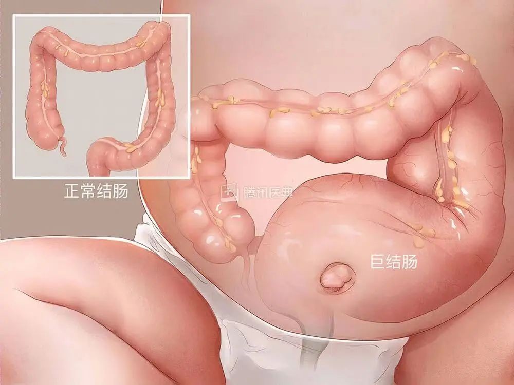 30天的小孩子肚子鼓鼓的硬硬的,儿童肚子胀得像大气球