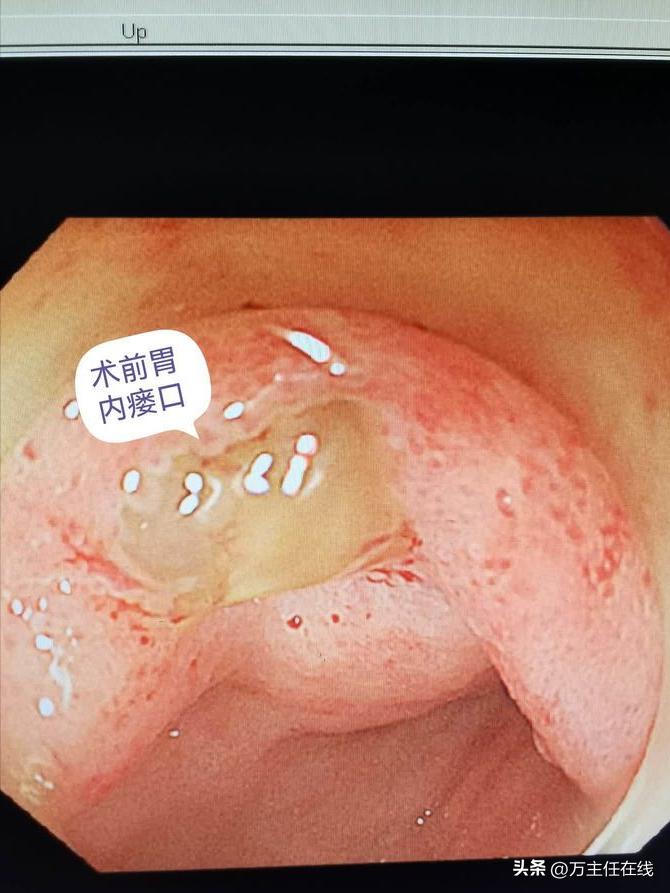 腹腔粘液癌治疗有妙招——万荣教授以内镜Notes技术成功胃减压