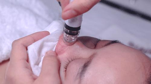 维a酸乳膏可以缩小毛孔吗,光子嫩肤可以缩小毛孔吗