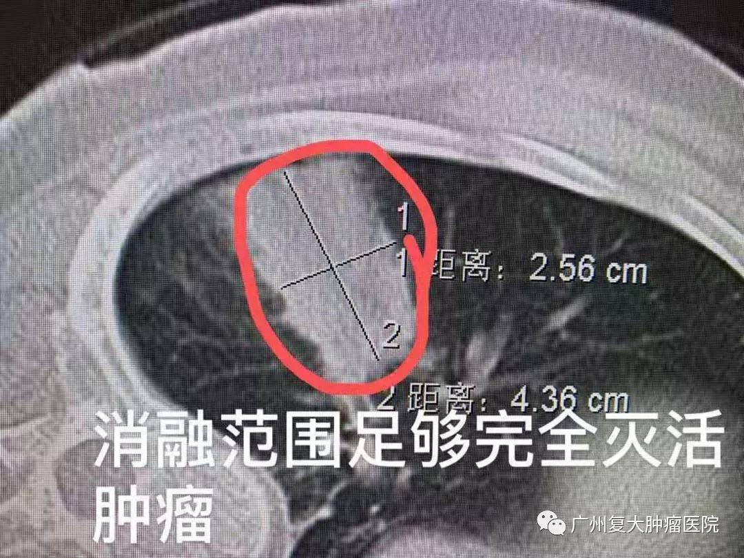 肺结节该观察还是手术？或许微创消融治疗是个不错的选择