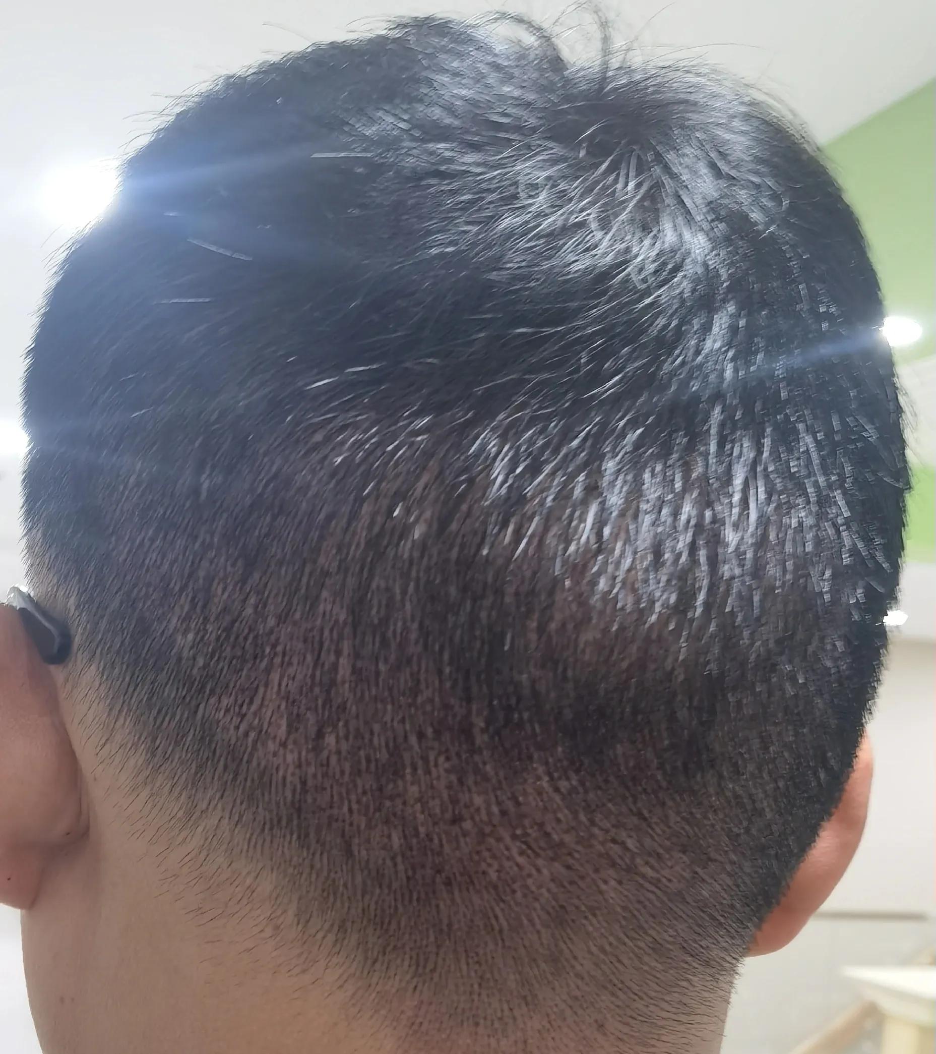 雄脱植发的亲身经历和感受,16000字讲述植发真实感受