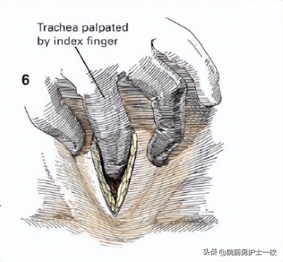 关于气管切开技术流程及注意事项