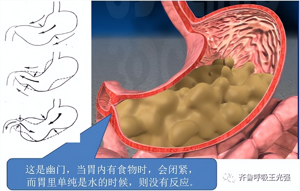胃食管反流病的偏方,胃食管反流病最新治疗