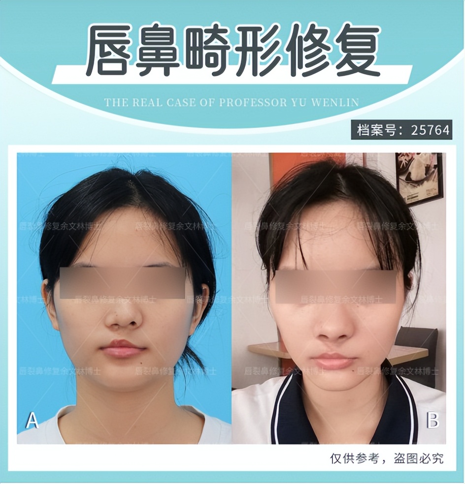 天生歪脖可以矫正吗,天生歪嘴能治好吗成人