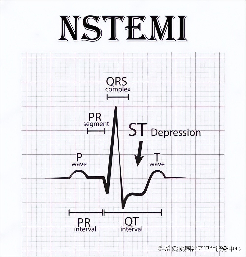 后循环梗死的识别,梗死分为哪三大类型