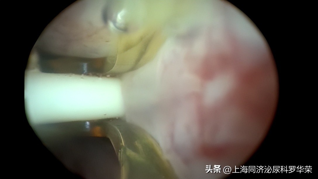 前列腺热消融术是什么方法,前列腺热消融治疗需要4到6周期