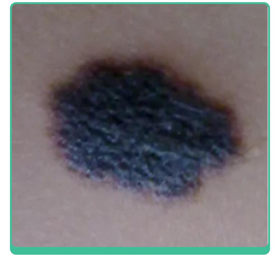 宝宝手上长胎记，一查竟是血管瘤！医生：这5种胎记要早处理