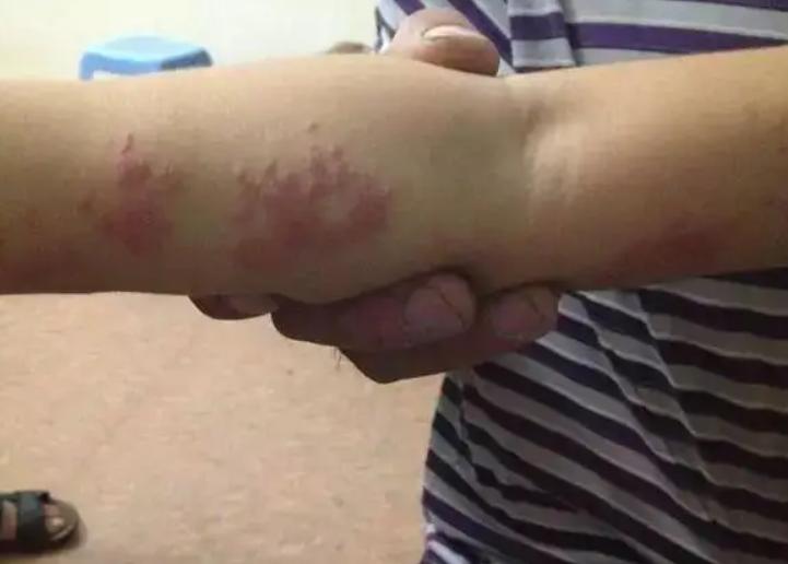 别把艾滋病当皮肤病,别错把艾滋当成皮肤病