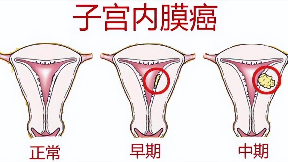 绝经3年又来例假是癌吗,绝经3年了还会排卵来例假吗