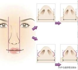 整形科普隆鼻应关注的几个问题,隆鼻为什么那么多人修复