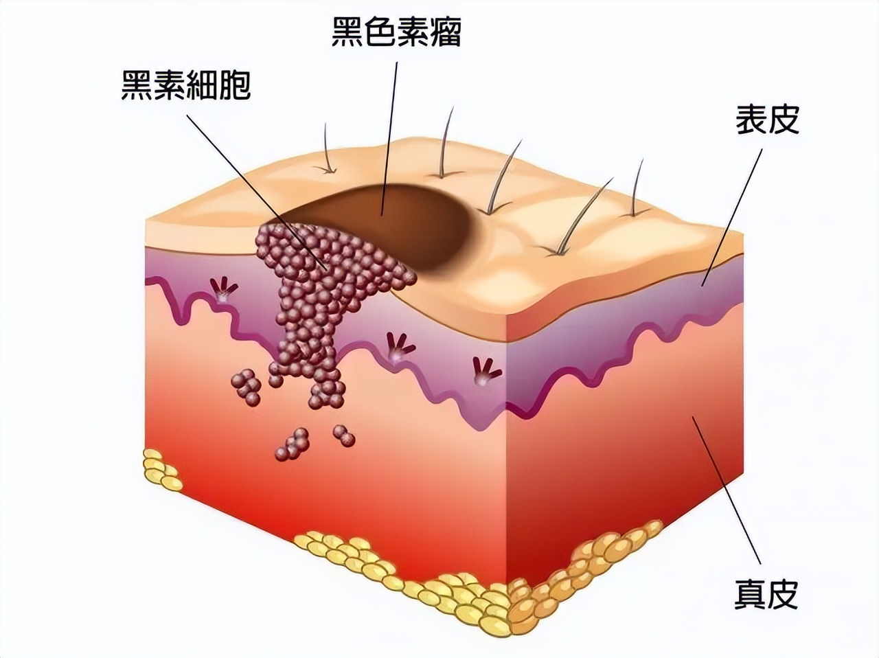 黑痣和黑色素沉着有何区别,什么样的黑痣要警惕可能会恶变