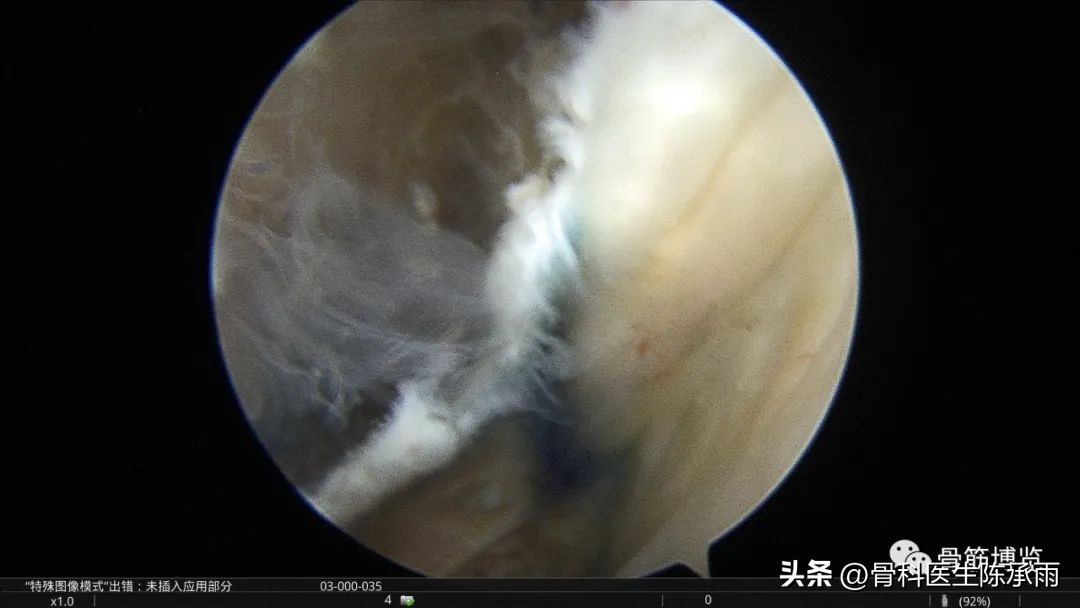 腘窝囊肿关节镜下切除复发,膝关节镜下腘窝囊肿切除的原理