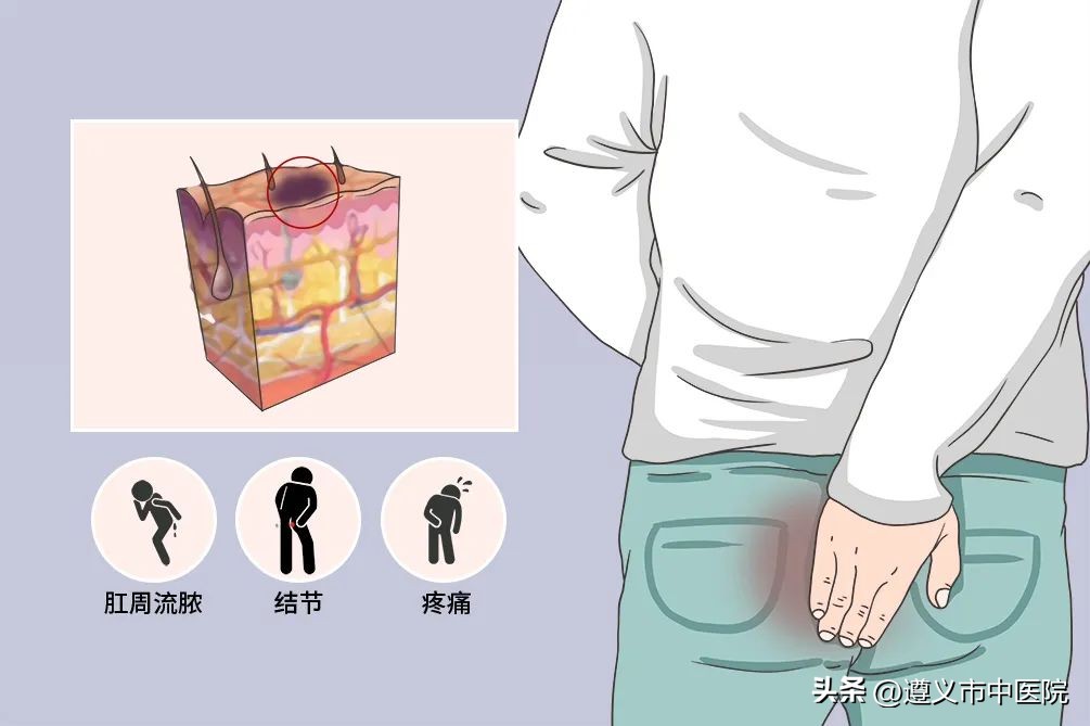 肛周汗腺炎最快自愈方法,肛周化脓性汗腺炎的中医病名