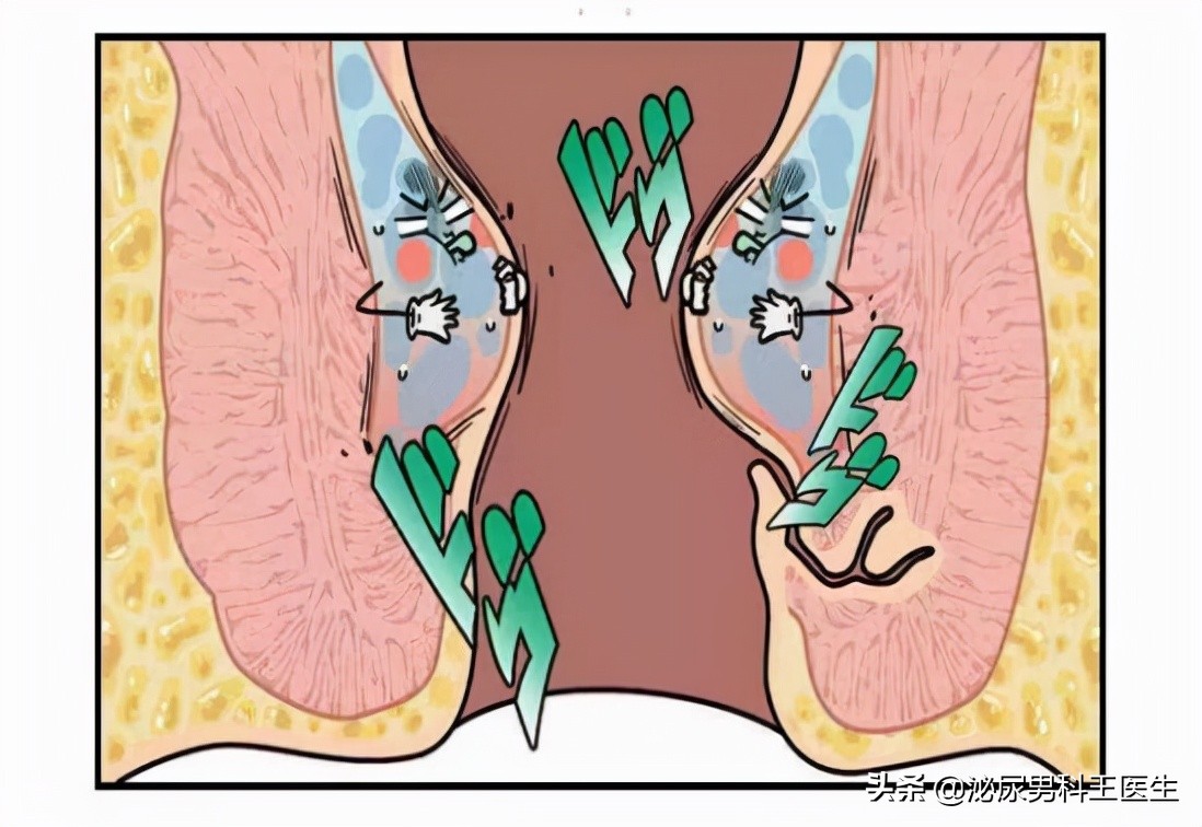肛门发痒有分泌物,肛门潮湿发痒有分泌物怎么治