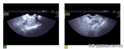 42岁左右女性输卵管炎怎么治疗好,女下腹疼痛伴有发烧37.5