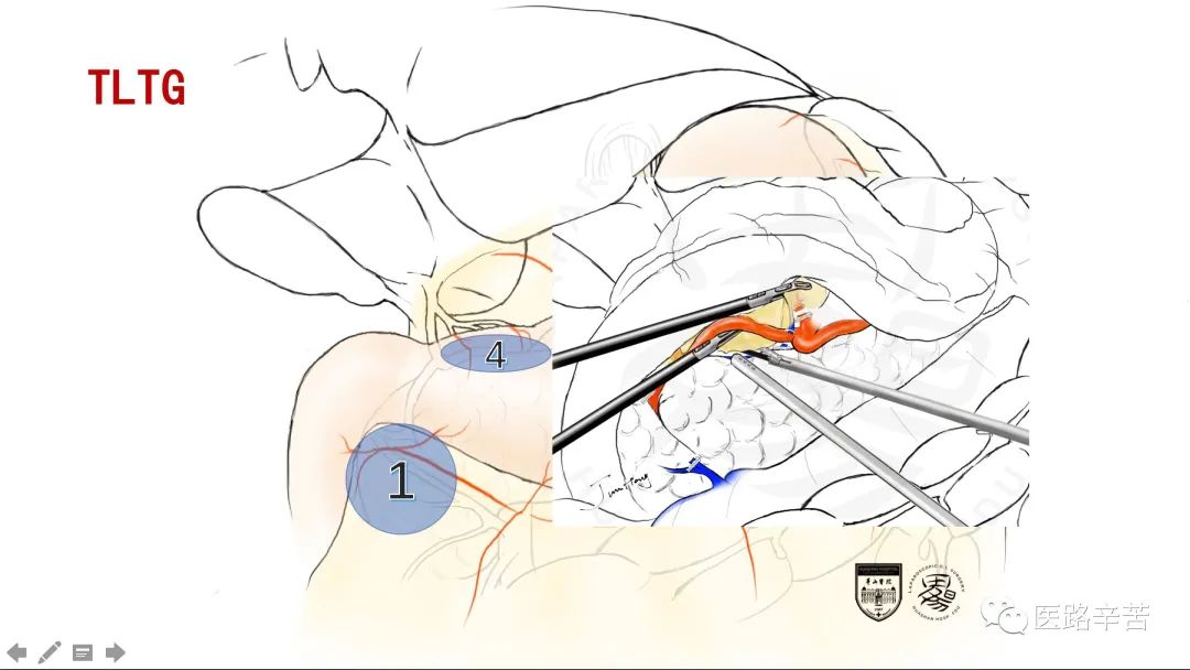 全腹腔镜胃癌根治术，学习大咖怎么清扫淋巴结