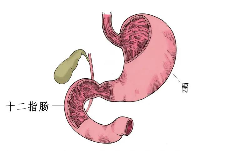 新乡中医讲十二指肠球炎症