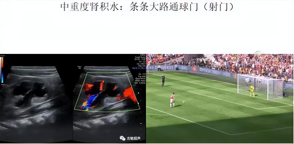 明知山有虎,偏向虎山行——肾斗士VS肾结石