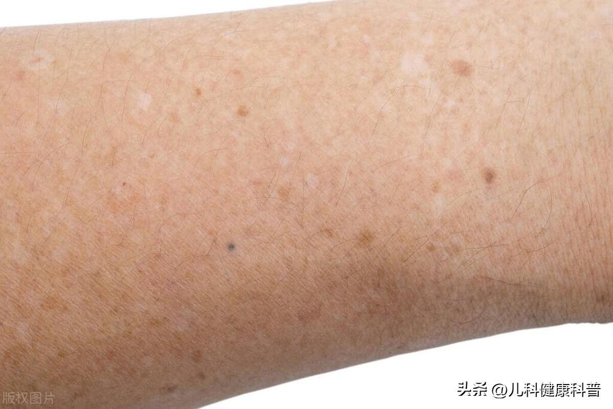 孩子脸上开始长白斑怎么回事,孩子身上出现白斑家长不要着急