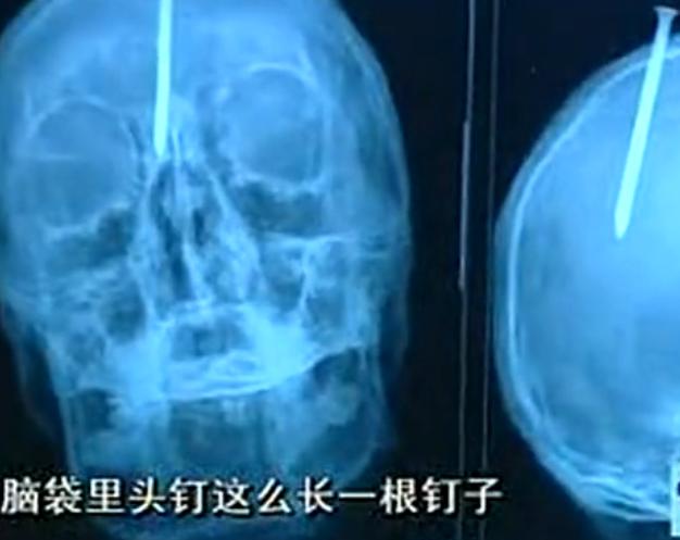 男子头上扎45毫米钢钉,小伙脑袋射了7根钢钉