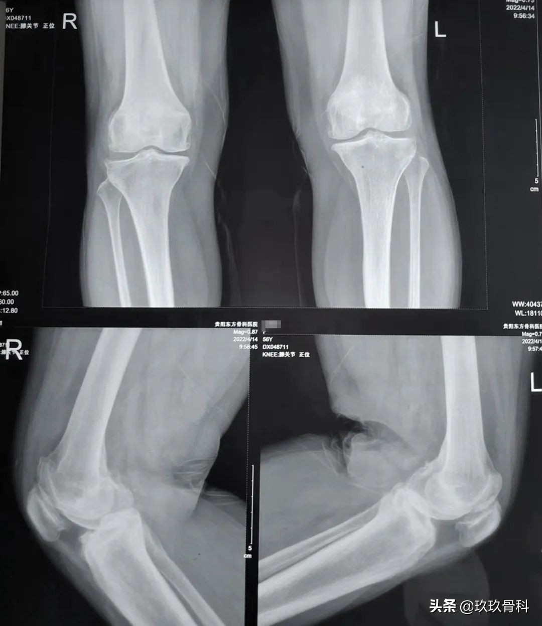 力达康XU单髁假体治疗“双膝”骨性关节炎——贵阳东方骨科医院