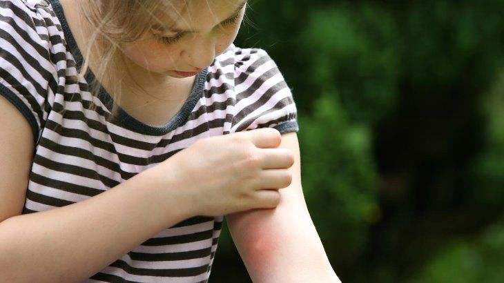 宝宝被蚊子咬了肿痒擦什么,宝宝被蚊子咬特别肿怎么办