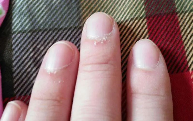 手指上长出了倒刺,要小心,不要随意乱拔,注意方式