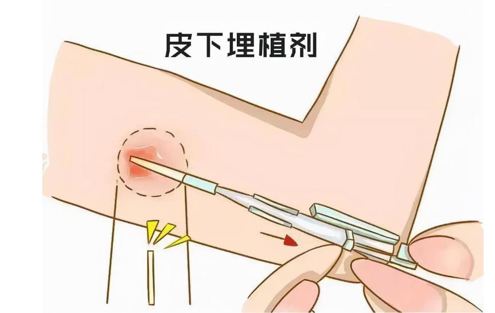 这种避孕方式，一劳永逸，为何外国人都在用，国内却少有人用？