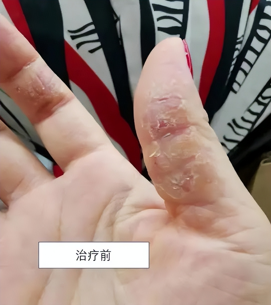 只需2步搞定宝宝湿疹,0-1岁祛湿疹的药