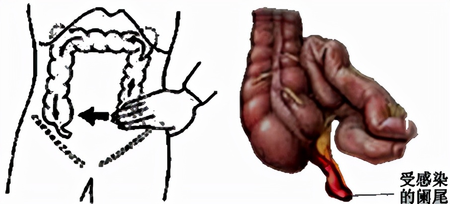 怀孕早期发现有阑尾炎怎么办,怀孕得阑尾炎怎么办胎儿能要吗