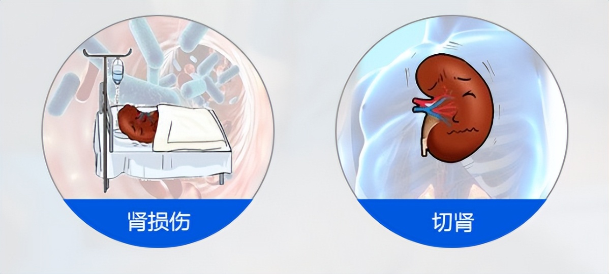 出现肾结石问题一定要明白这几点,关于肾结石你了解多少