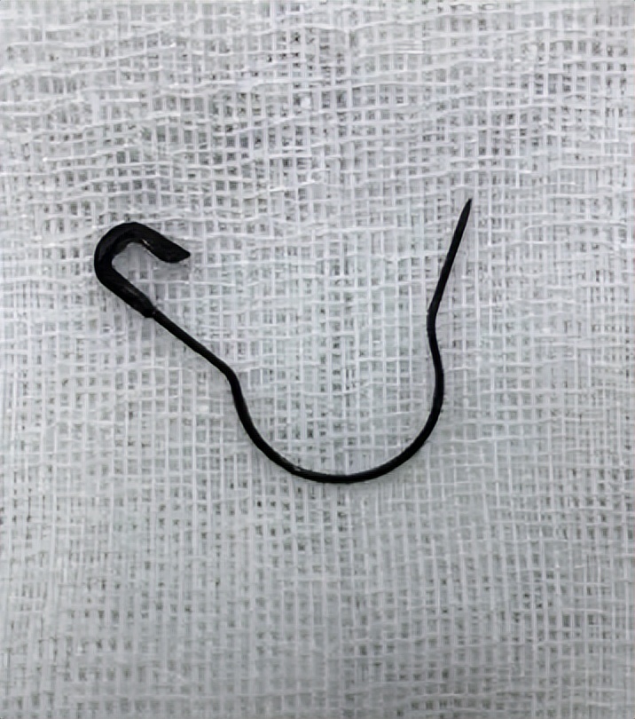 11个月大婴儿,吞下一枚3cm钉子!家长平时一定要收好家中小物品