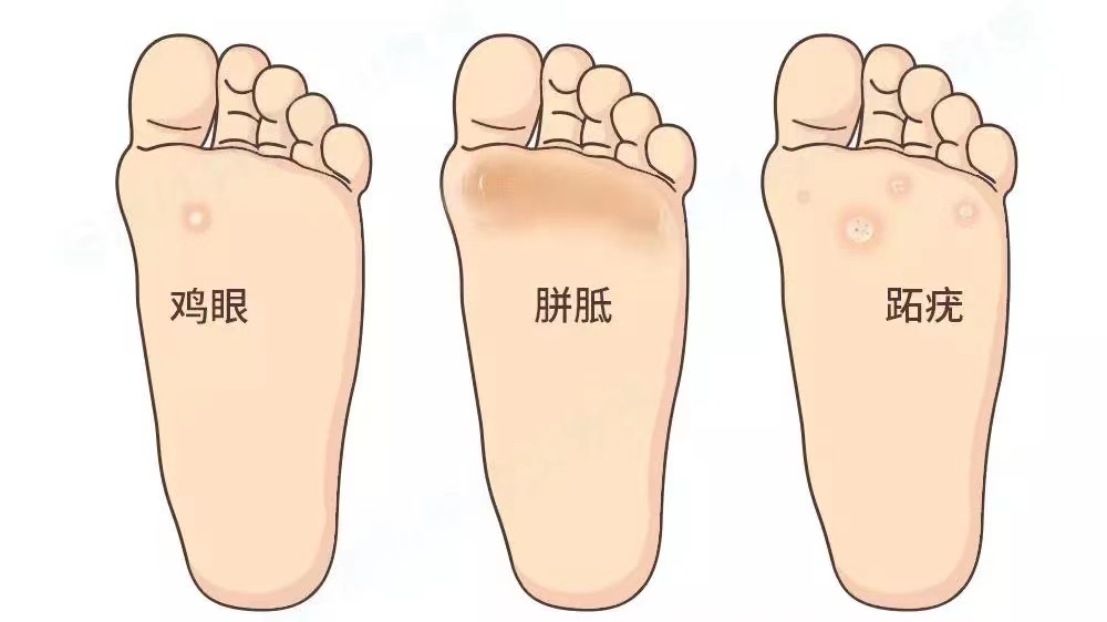 脚底板爱进风什么原因,脚底板长茧子走路疼怎么办