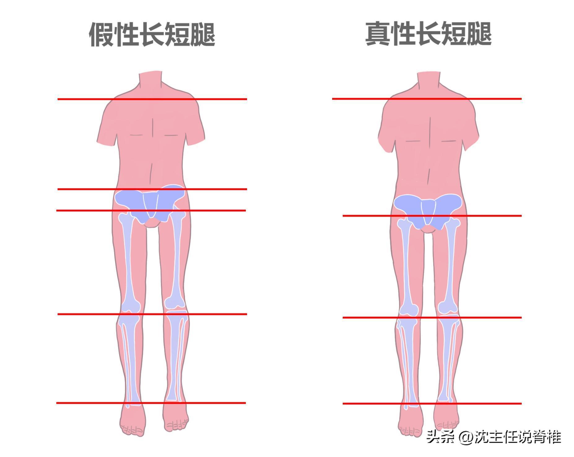 长短腿自测及改善方法,真假长短腿矫正训练动作