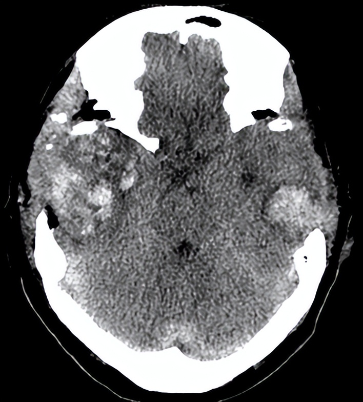 医院成功救治重型颅脑患者,特重型颅脑损伤治愈案