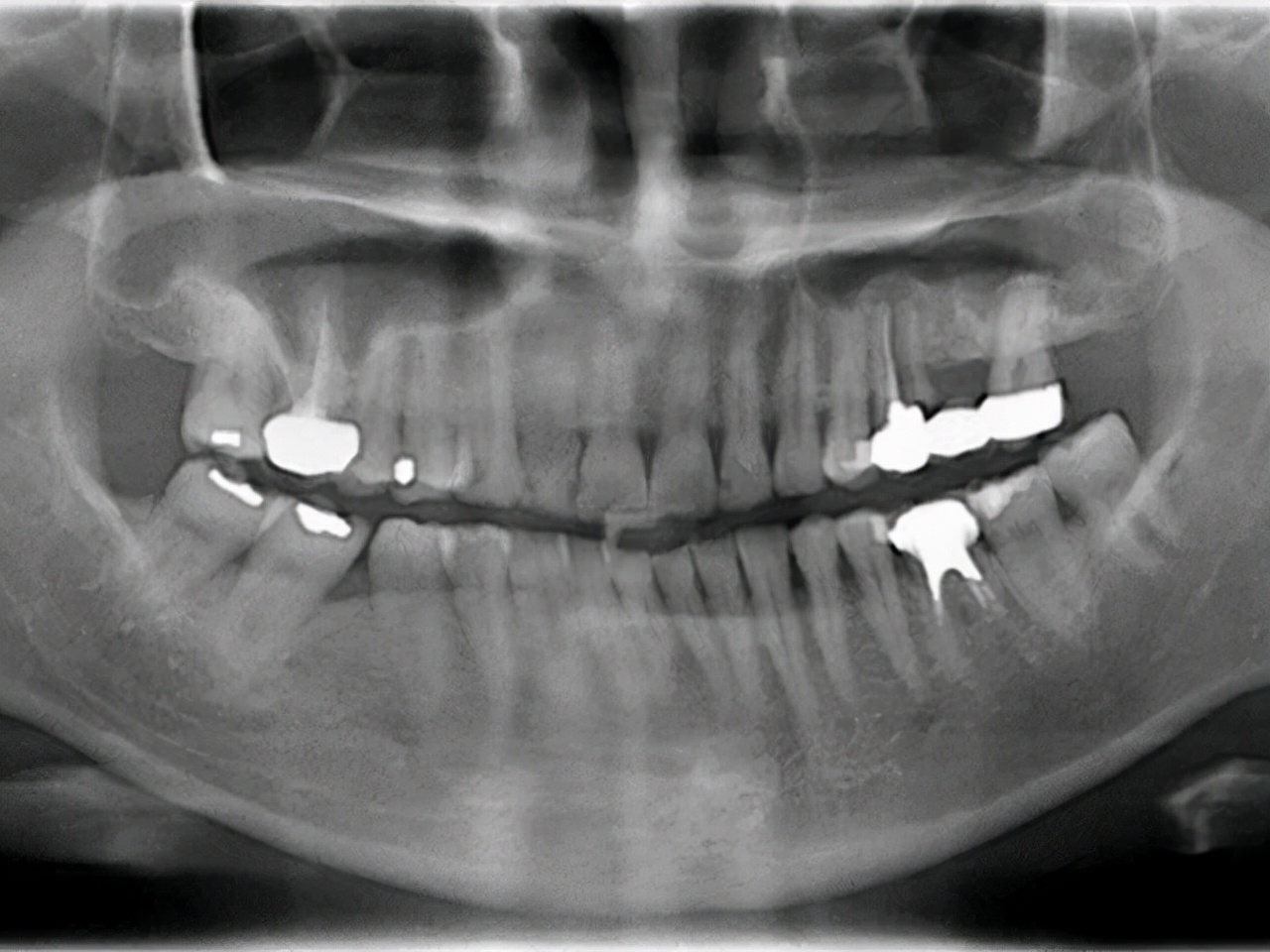 牙齿松了怎么治疗最好,牙齿松了怎么办教你如何快速恢复