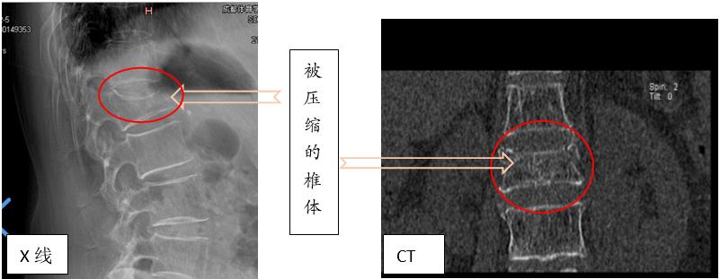 胸腰椎压缩性骨折特色治疗方法,老年人胸腰椎骨折怎么治疗