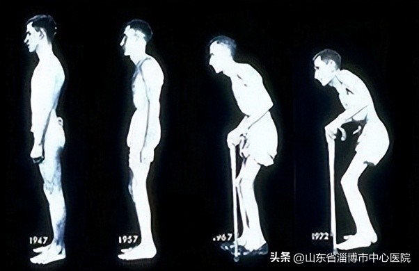 市中心医院风湿免疫科举办5.6国际强直性脊柱炎日义诊及健康宣教