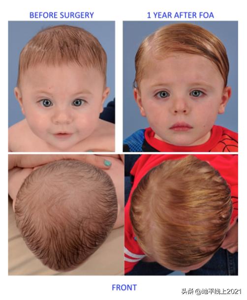 额头上凸起的像犄角一样怎么改善,婴儿额头突出有犄角
