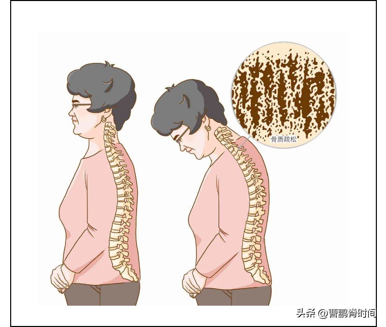 跳绳导致胸椎压缩性骨折,跳绳跳到肋骨脱臼