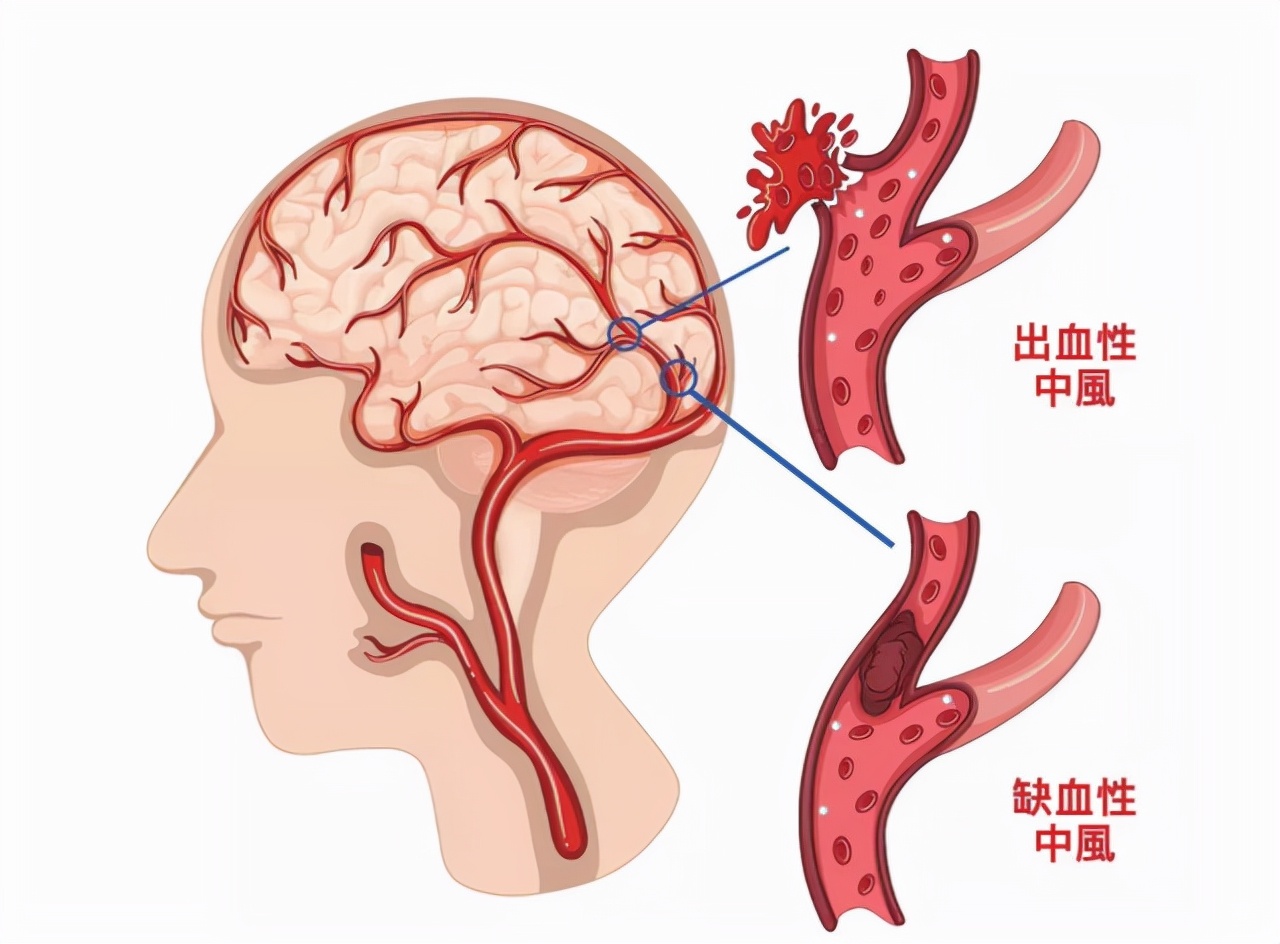 血压高到多少才会发生脑出血,血压升到多少脑出血