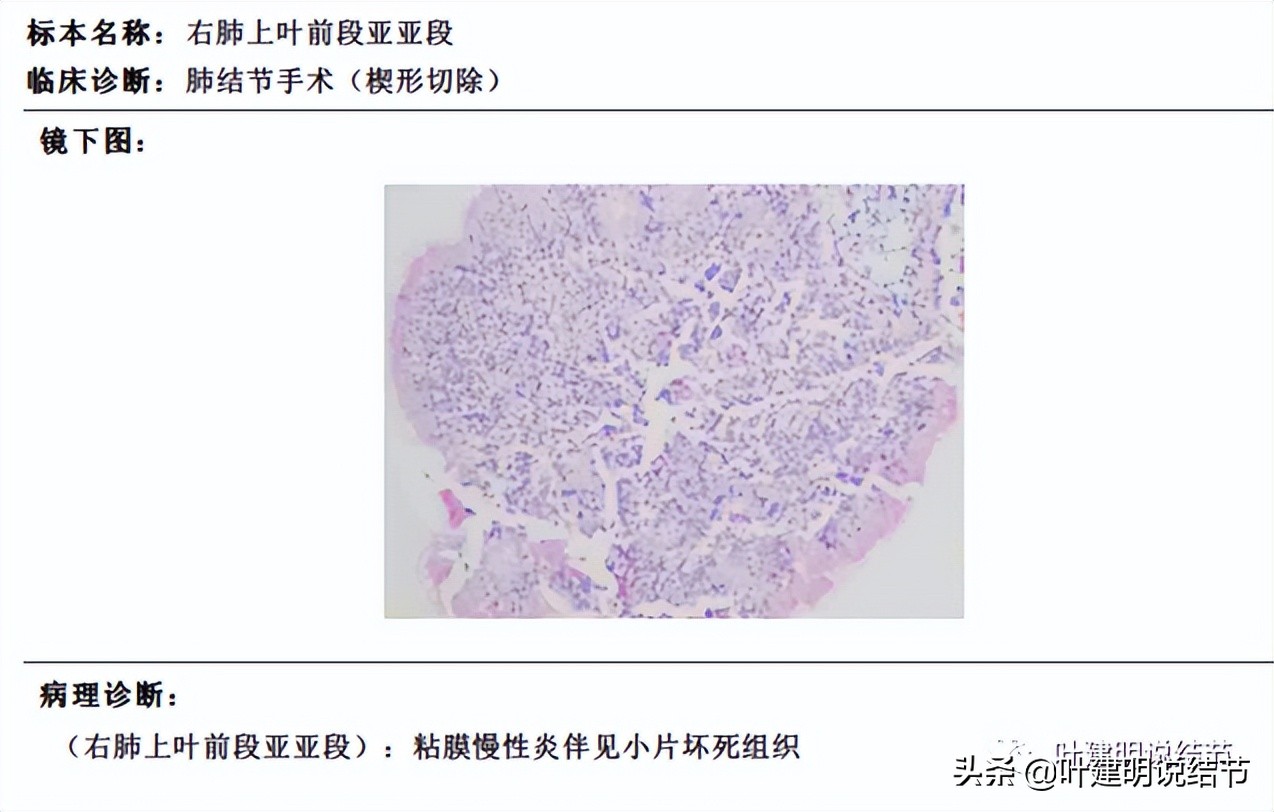 经验：肺占位超6厘米，不是癌还会是什么？临床上仍得多个心眼