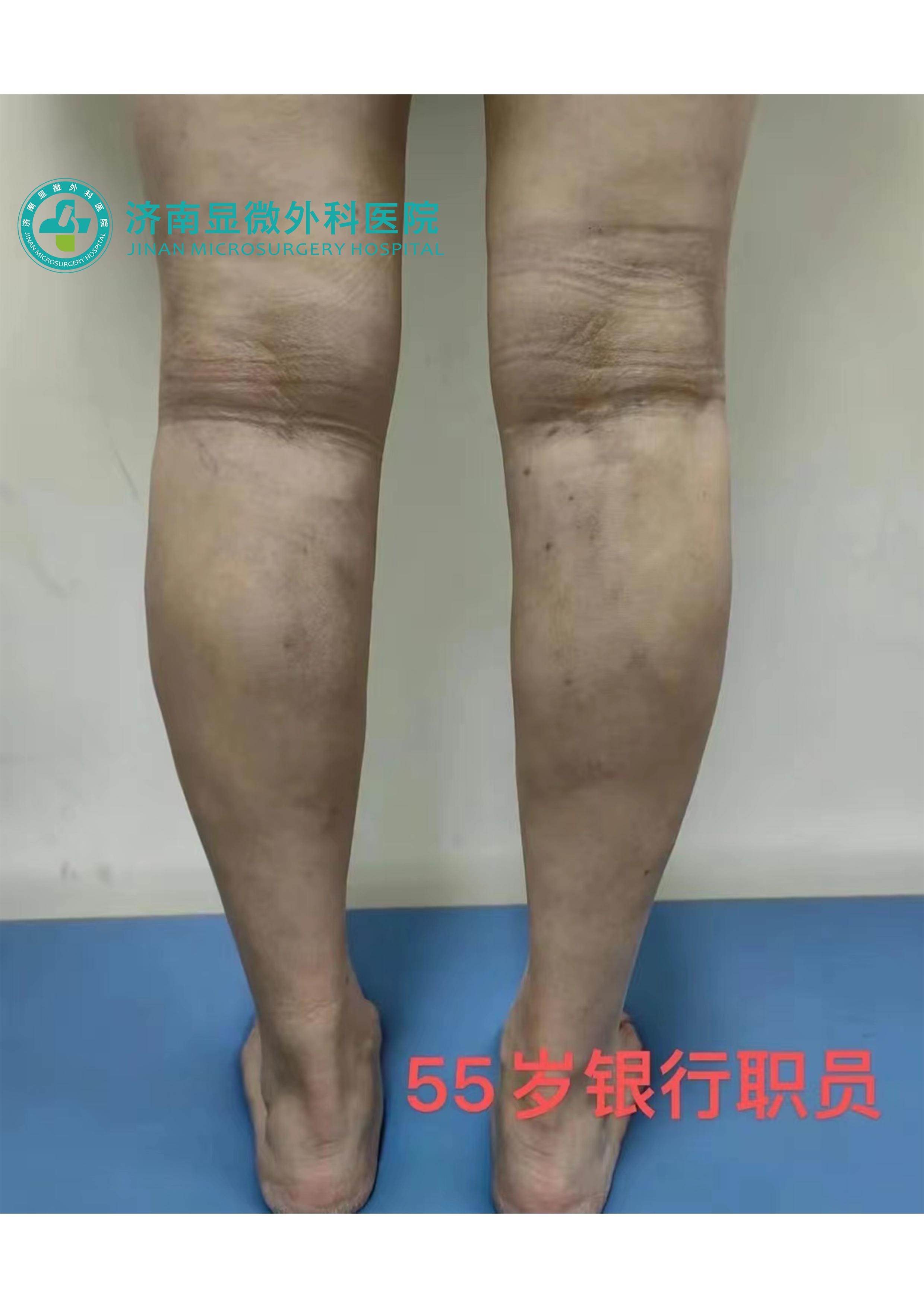 现在治疗静脉曲张有哪些治疗方法,杨医生治静脉曲张