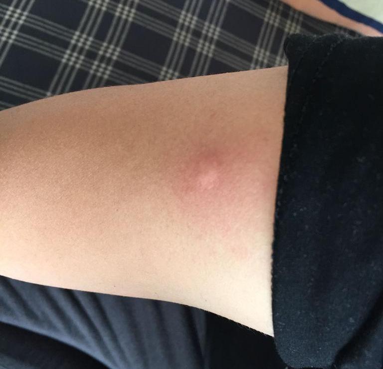 链球菌感染的患者，有发热的症状，比较常见，但多数人没有重视