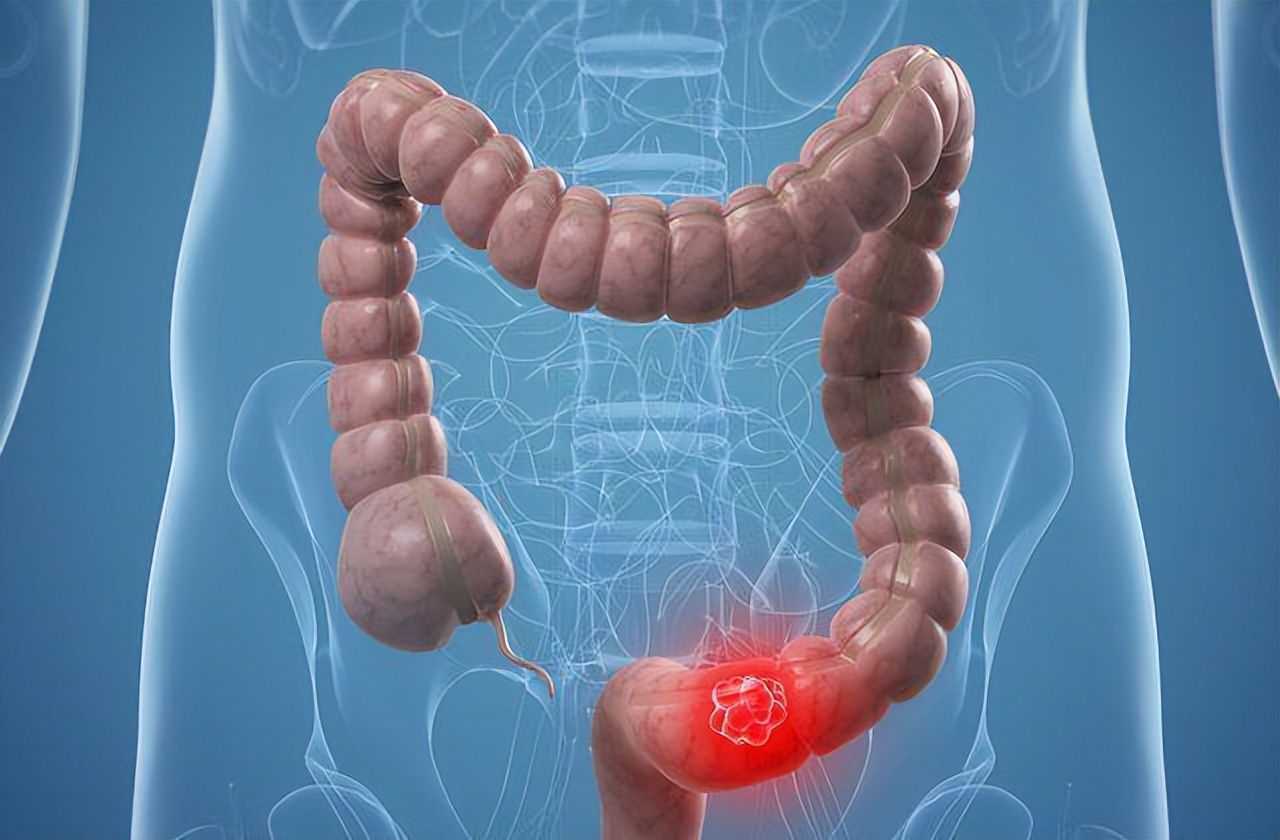 从炎症到癌症三种炎症别拖着,从炎症到癌症以下几种炎症不要拖