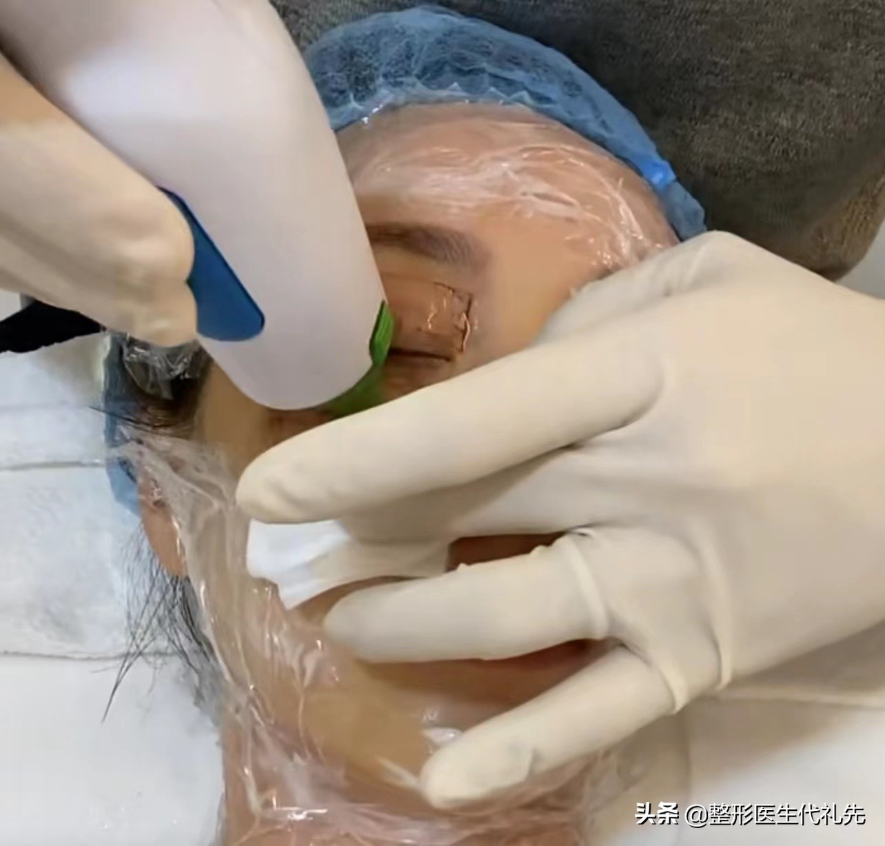 眼下细纹除皱教程,眼下细纹怎么去除做手术