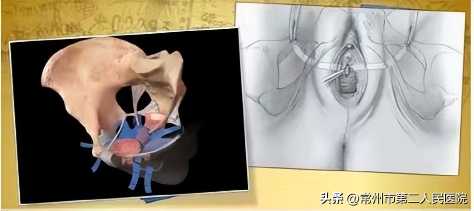 盆底康复呵护女性,如何预防盆底肌疾病