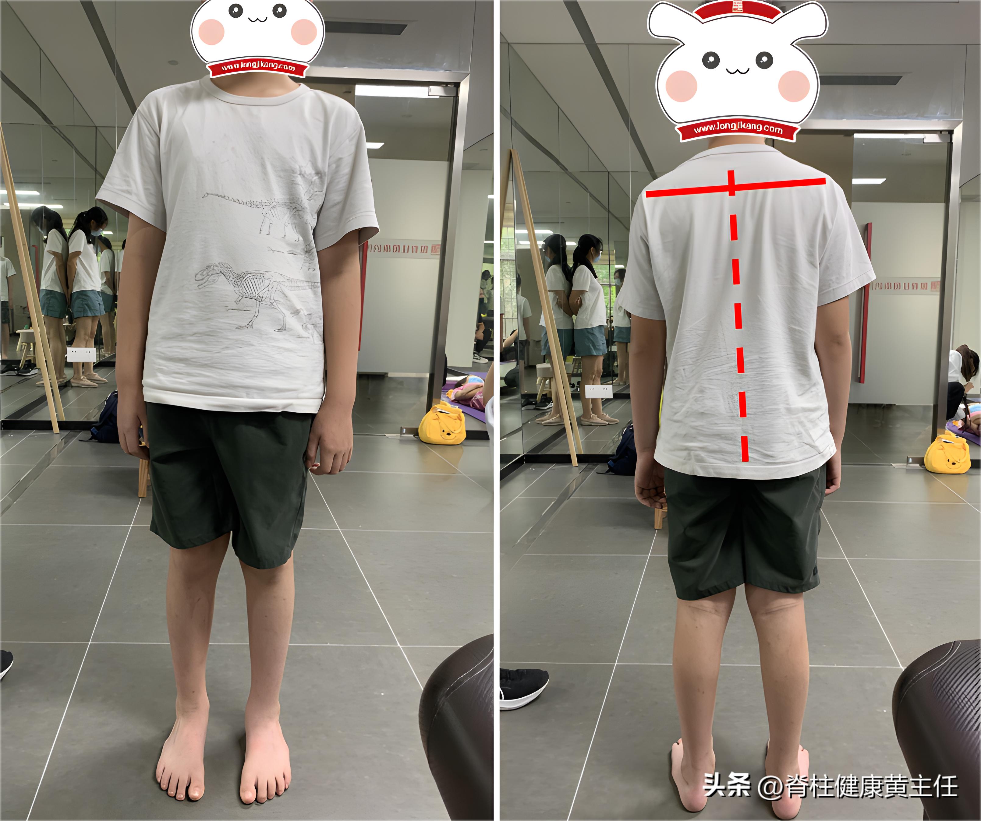 扁平足o型腿骨盆前倾高低肩,一只脚是扁平足怎么矫正