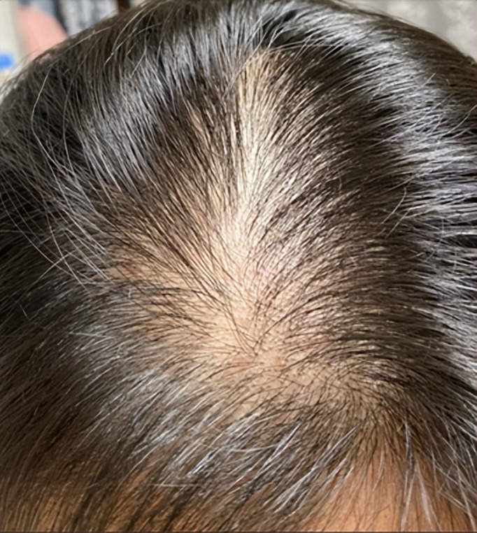 米诺地尔长头发的原理,用米诺地尔能长头发吗