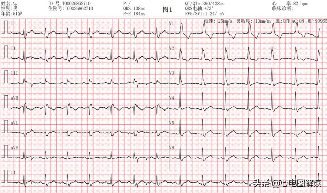 完全性右束支阻滞和t波改变,完全性右束支传导阻滞和t波改变